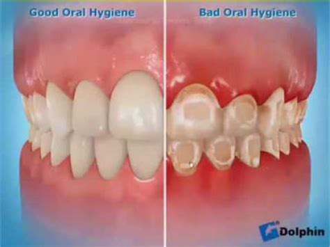 Bad Teeth After Braces - Dental News Network