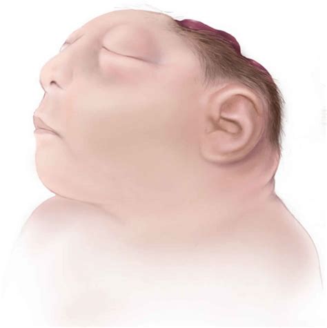 Anencephaly causes, symptoms, diagnosis, prognosis & anencephaly treatment