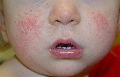 Acrodermatitis: Causes, Symptoms, Treatment and Prevention — Healthdigezt.com