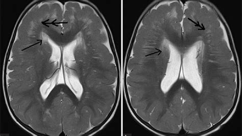 Technical Info on Pachygyria and Lissencephaly Levels – Making ...