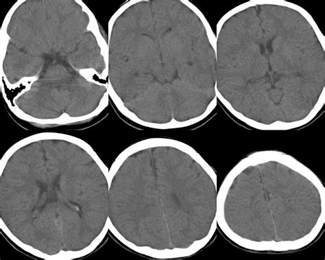 Ischemic: Hypoxic Ischemic Encephalopathy Mri