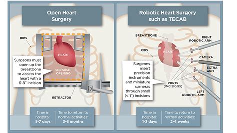 Robotic heart surgery: What you need to know - UChicago Medicine