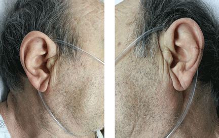 Bilateral earlobe creases and coronary artery disease | Cleveland ...