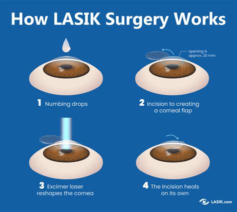 How Does LASIK Eye Surgery Work? | LASIK.com™ Official Site