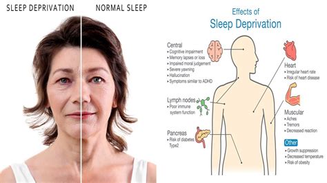 10 Scary Side Effects Of Sleep Deprivation - YouTube