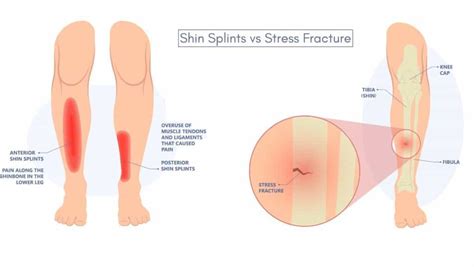 Shin Splints vs Stress Fracture: Differences by a Foot Specialist