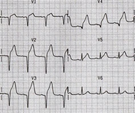 Q Wave • LITFL • ECG Library Basics