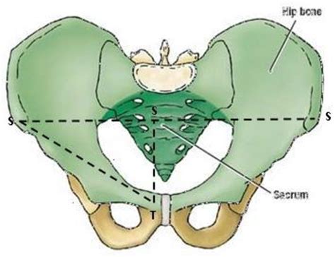 Figure 7 from Role of Low Lying Pubic Tubercle in the Development of Inguinal Hernia: A Case ...