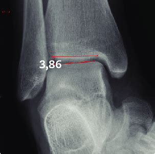 Stress in radiographic varus. | Download Scientific Diagram