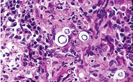 Blastomycosis Histology