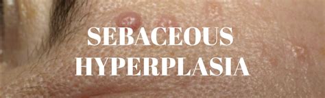 Sebaceous Hyperplasia - Beautyologist