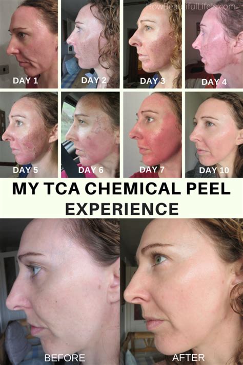 My TCA Chemical Peel Experience | How Beautiful Life Is