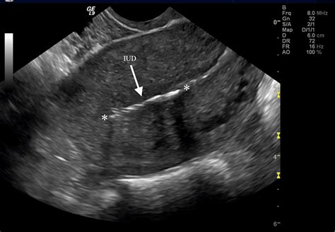 Intrauterine Ultrasound