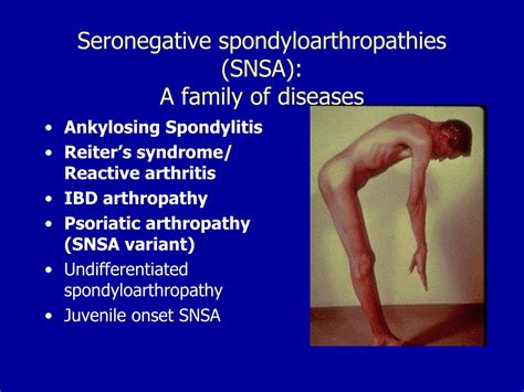 PPT - Seronegative Spondyloarthropathies PowerPoint Presentation, free download - ID:6039323