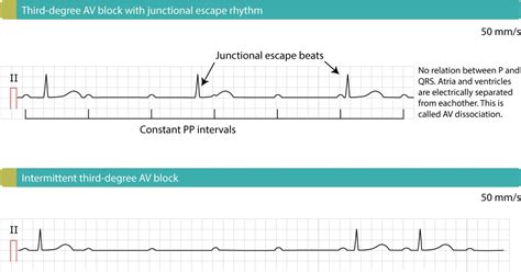 Third-degree AV block (3rd degree AV block, AV block 3, AV block III) – ECG learning