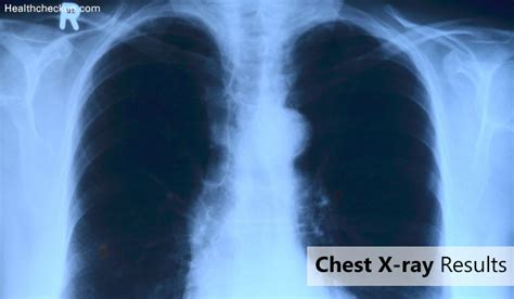 Chest X-ray Results : Test Procedure, Preparation and Risks