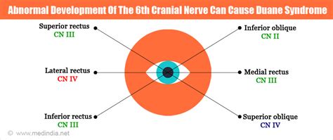 Duane’s Syndrome - Causes, Types, Symptoms, Diagnosis, Treatment ...