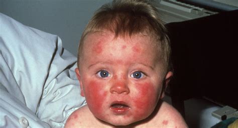 Fifth disease in babies | BabyCenter