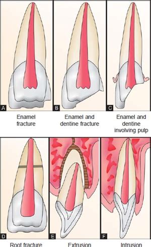 Ellis classification for tooth fracture | News | Dentagama