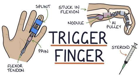 Trigger Finger Definition Etiology Symptoms Diagnosis