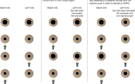 Figure 2 from How to test for a relative afferent pupillary defect ...