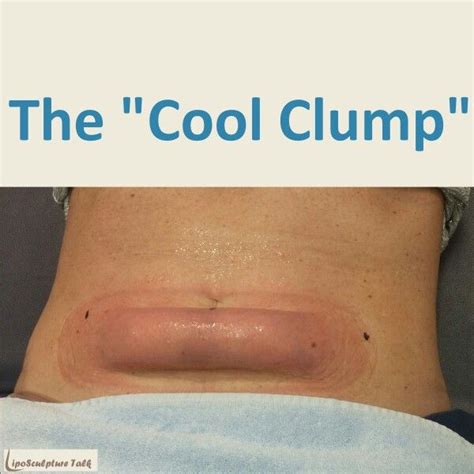 It can be rather startling to look down after a #Coolsculpting ...