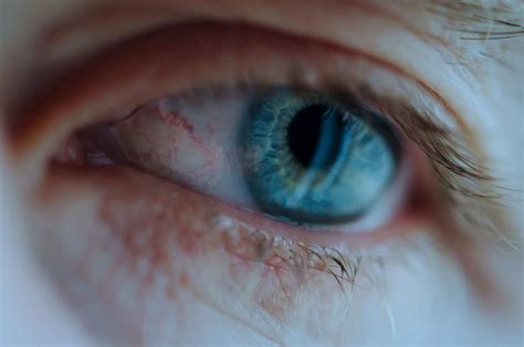 Ocular Rosacea: Treatment, Symptoms, & Causes | Michigan Eye Institute