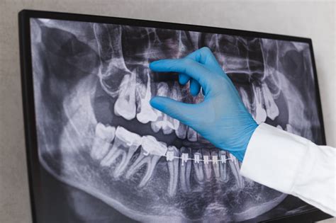 Understanding Different Types Of Dental X-Rays And Their Applications ...