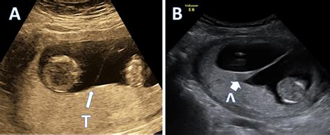 Lambda And T Sign In Twin Pregnancy / In dichorionic diamniotic twin pregnancy, there is a ...