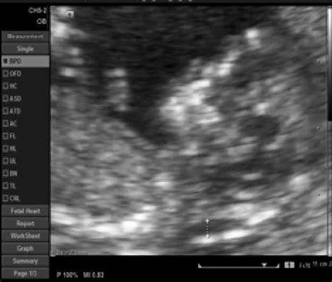 Ultrasound image of the fetus at 12 weeks, showing the nuchal... | Download Scientific Diagram