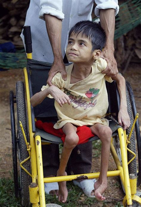 Agent Orange Victims: Haunting Photos Of The Unpunished War Crimes Of U ...