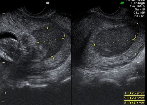 Successful outcome after spontaneous first trimester intra-amniotic haematoma and early preterm ...