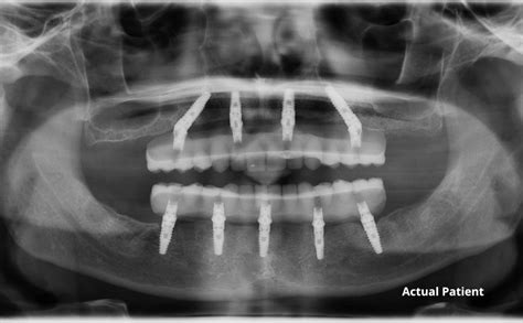 Dental Implants Xray