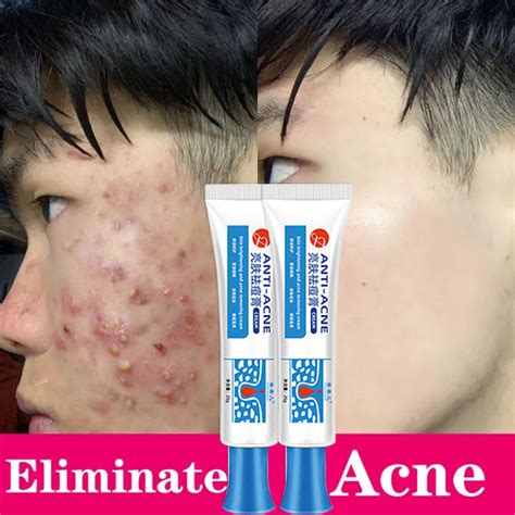 100% Effective Remove Pimples Quickly Pimple Remover Acne Cream Fades ...