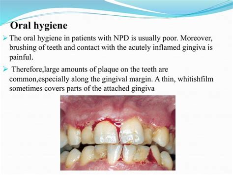 Necrotizing periodontal diseases by Dr Rinky Tripathi pg 2nd year periodontics Army College of ...