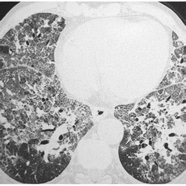 (PDF) "Crazy-Paving" Patterns on High-Resolution CT Scans in Patients with Pulmonary ...