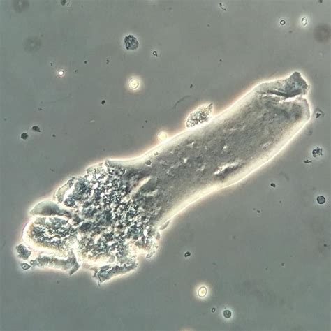 Waxy cast with broadened granular base in a patient with TTP and AKI 3. #urinarysediment #urine ...