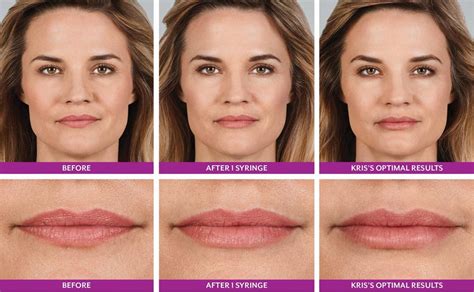 Lip Augmentation Plano TX Archives - Legacy Eyelids & Cosmetic Surgery