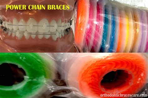 Power Chain Braces 101: Types, Colors, When Do You Get - Orthodontic Braces Care