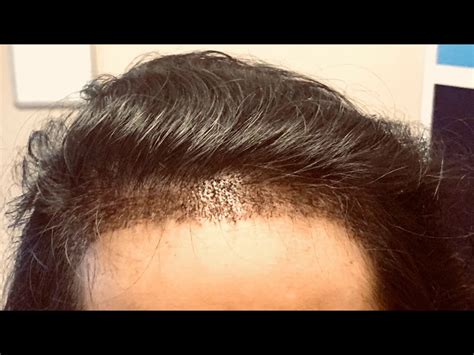 Female Hairline Lowering Dallas | Hair Graft for Women Plano