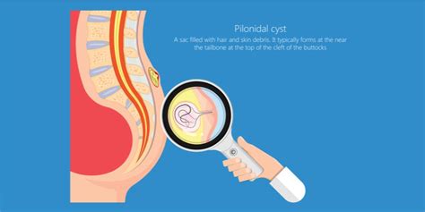 Who is likely to get the Pilonidal Sinus or Cyst? - Pristyn Care