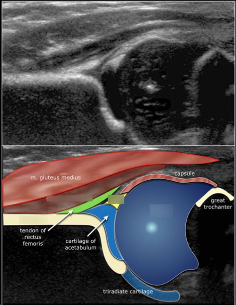 Neonatal Hip Diagram | Quizlet