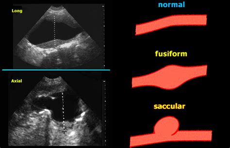 Sub-renal aortic dissecting saccular aneurysm - radRounds Radiology Network