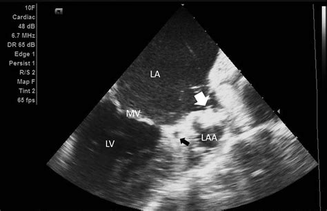 Left Atrial Appendage Closure Under Intracardiac Echocardiographic ...