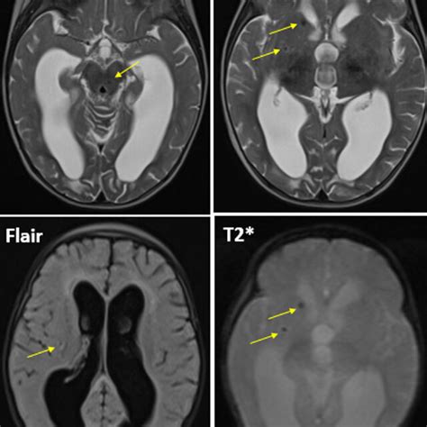 -Axial sections of a brain MRI in T2, T2 echo gradient and FLAIR... | Download Scientific Diagram