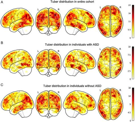 Fusiform Face Area Prosopagnosia