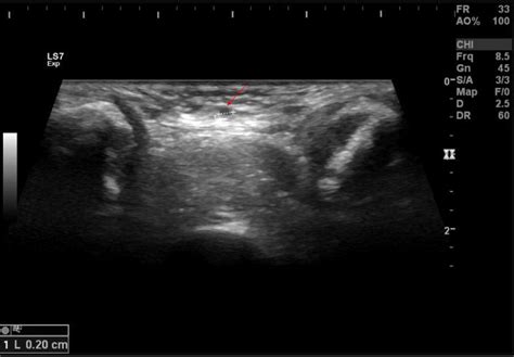 Midline cervical sinus: a rare branchial anomaly. | Eurorad