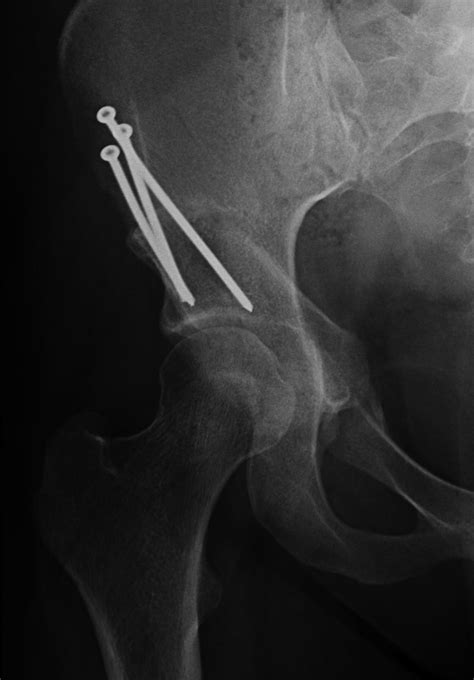 Matthew Boyle - Orthopaedic Surgeon - Periacetabular Osteotomy | PAO | Hip Dysplasia Surgery