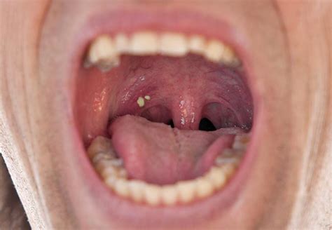 Are Troublesome Tonsil Stones Causing Your Bad Breath? – Health Essentials from Cleveland Clinic