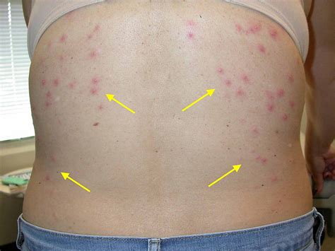 Hot Tub-Associated Pseudomonas Folliculitis: A Case Report and Review ...